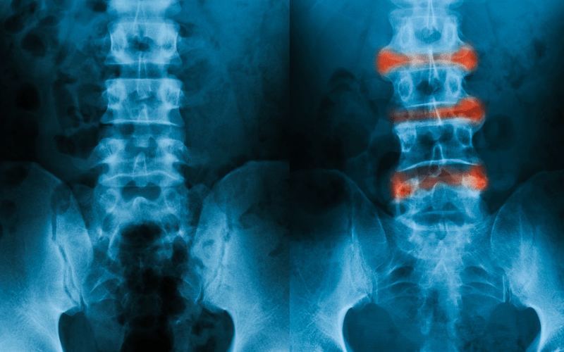 Espondilitis anquilosante